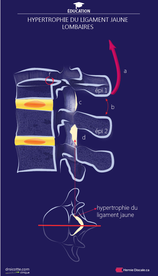 Comment soigner la sténose spinale cause hypertrophie ligament jaune. Le méchanisme d'action du traitement Cox®.