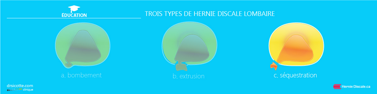 Trois types de hernie discale lombaire: séquestration.