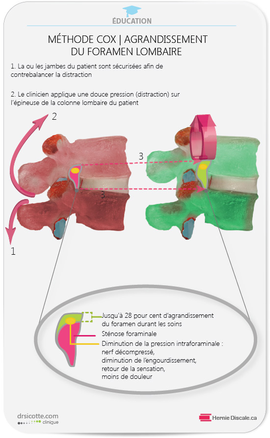 L'effet du traitement méthode Cox sur le foramen lombaire.